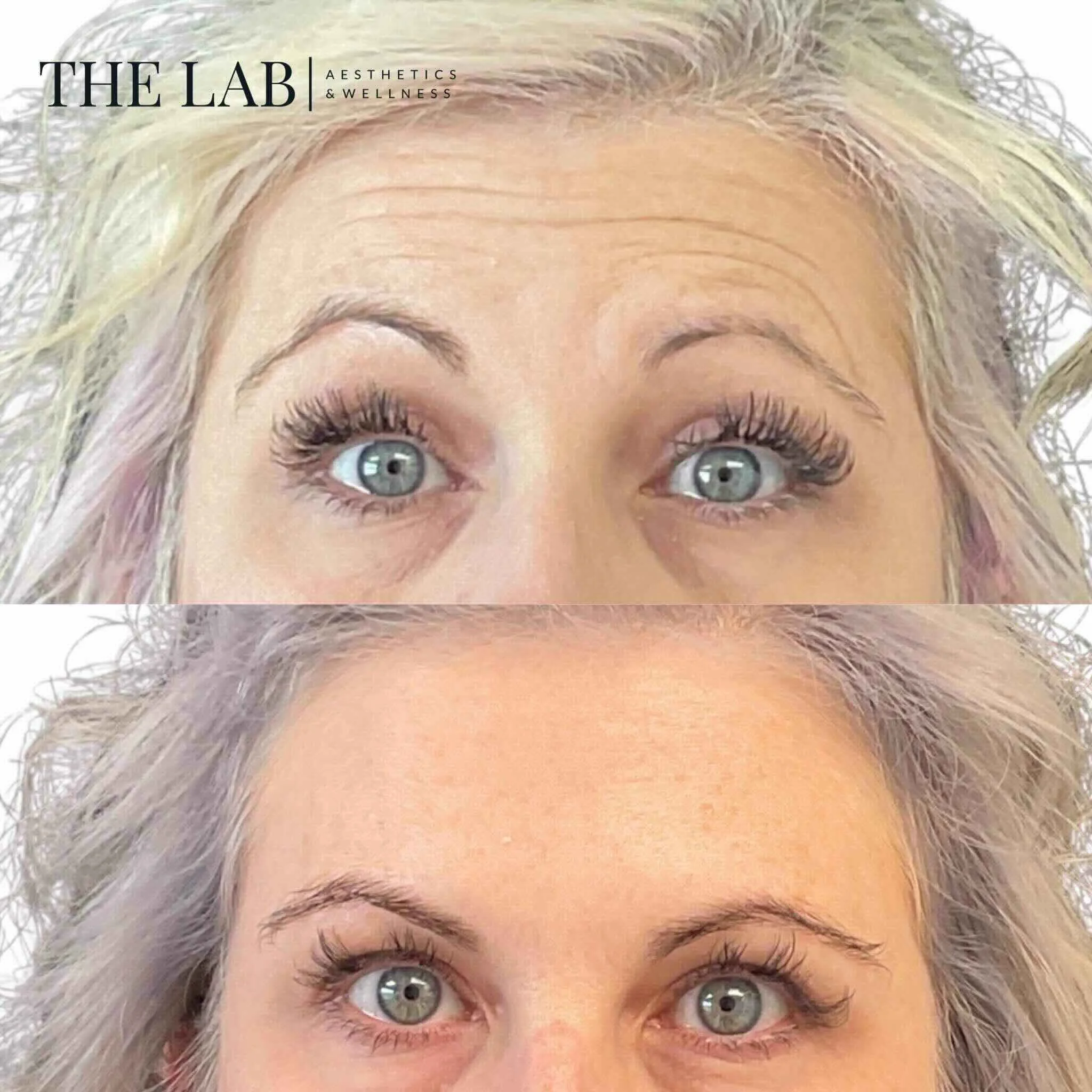 Upper Face Botox Results at The LAB Aesthetics and Wellness