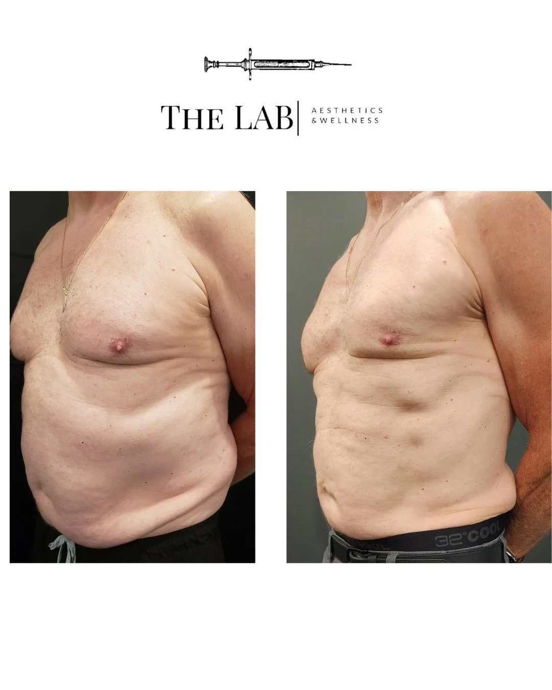 Before and after comparison of a man's chest showing skin tightening and reduction of sagging after a cosmetic procedure at The Lab Aesthetics & Wellness.