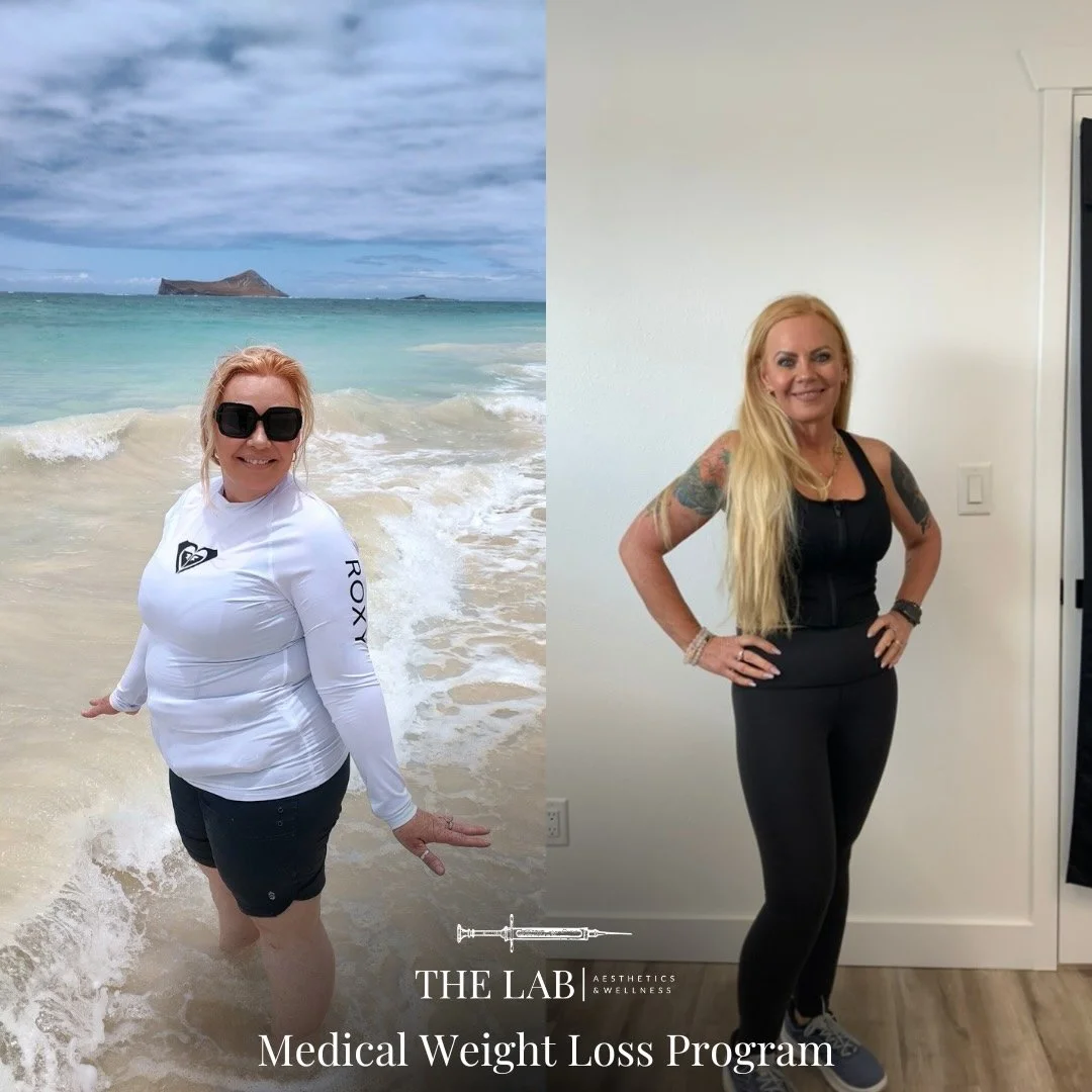 Before and after of GLP-1 weight loss