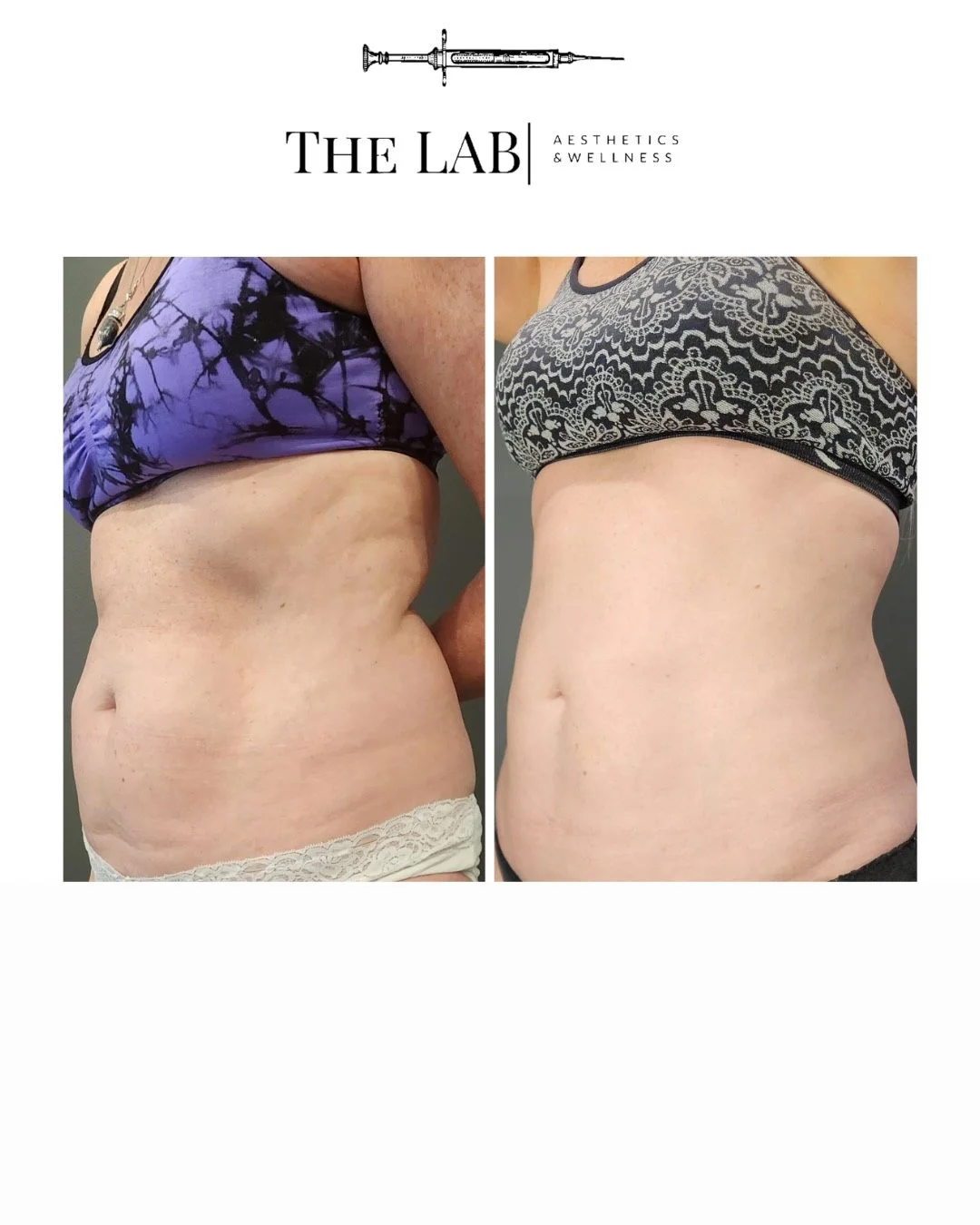 Side-by-side comparison of a woman's torso before and after body transformation, demonstrating a reduction in abdominal size and improved skin tone.