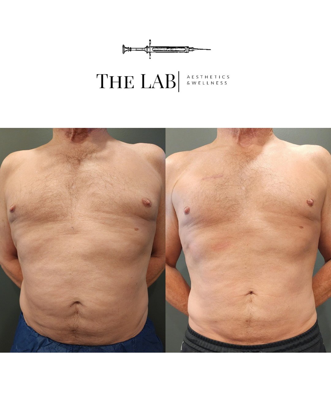 Before and after photos showing a man's chest and abdominal area, indicating a cosmetic or medical treatment result, with the logo of The Lab Aesthetics & Wellness at the top.