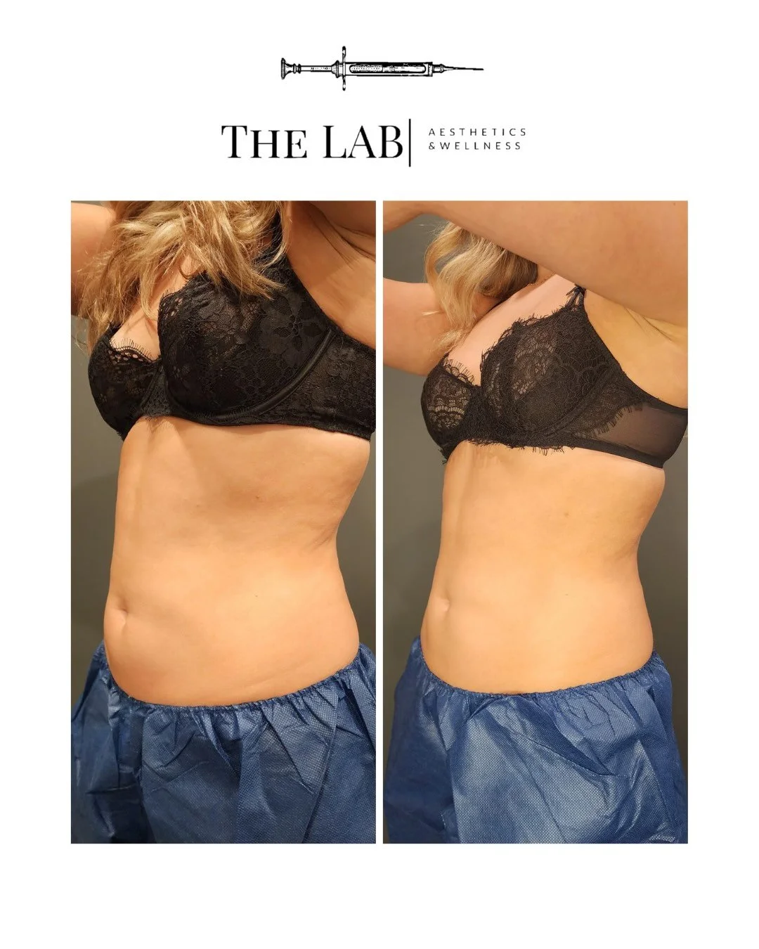 Side-by-side comparison of a woman's torso before and after a body treatment, showing improved skin texture and reduced cellulite, with her wearing a black lace top and blue scrubs.