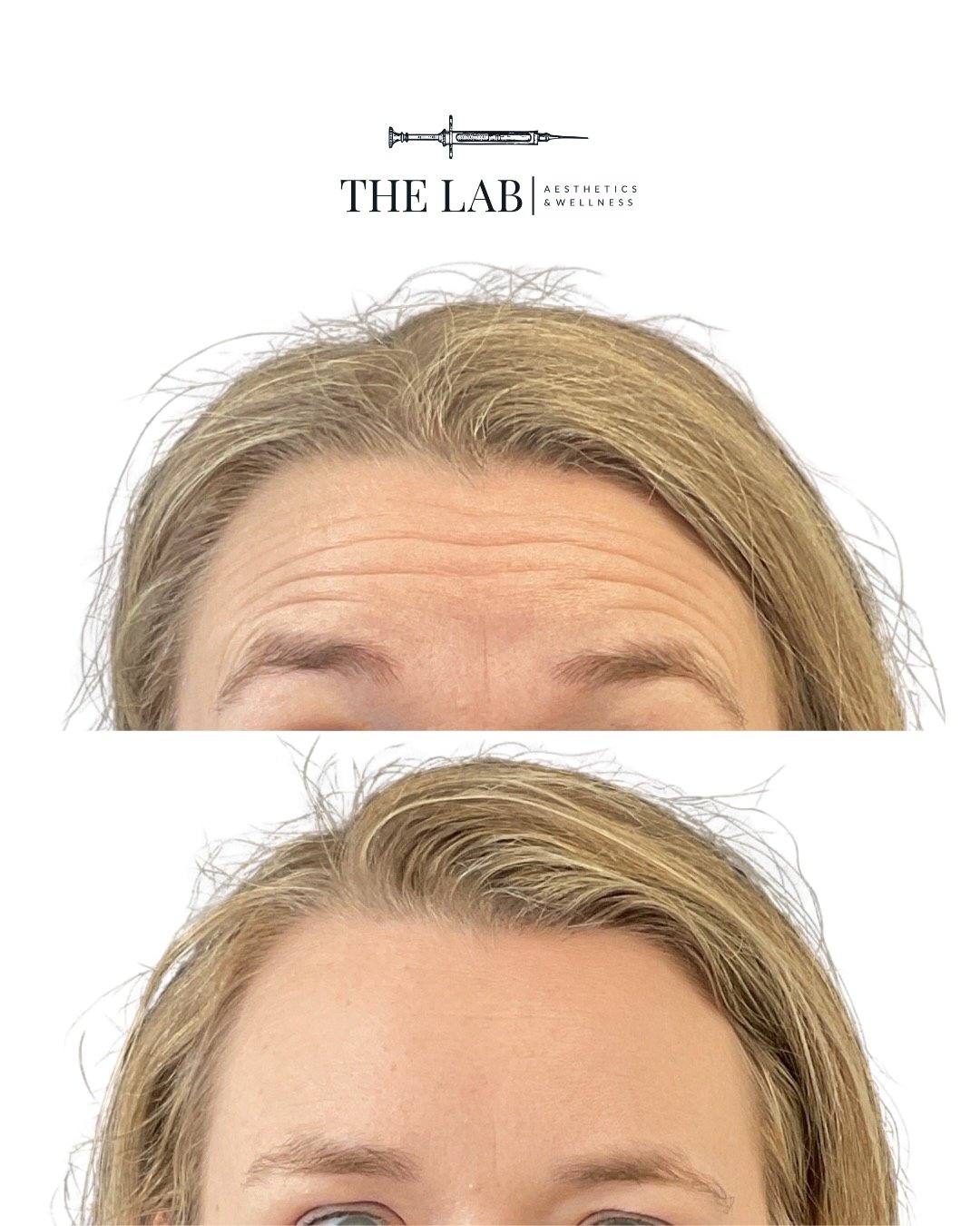Upper Face Botox Results at The LAB Aesthetics and Wellness