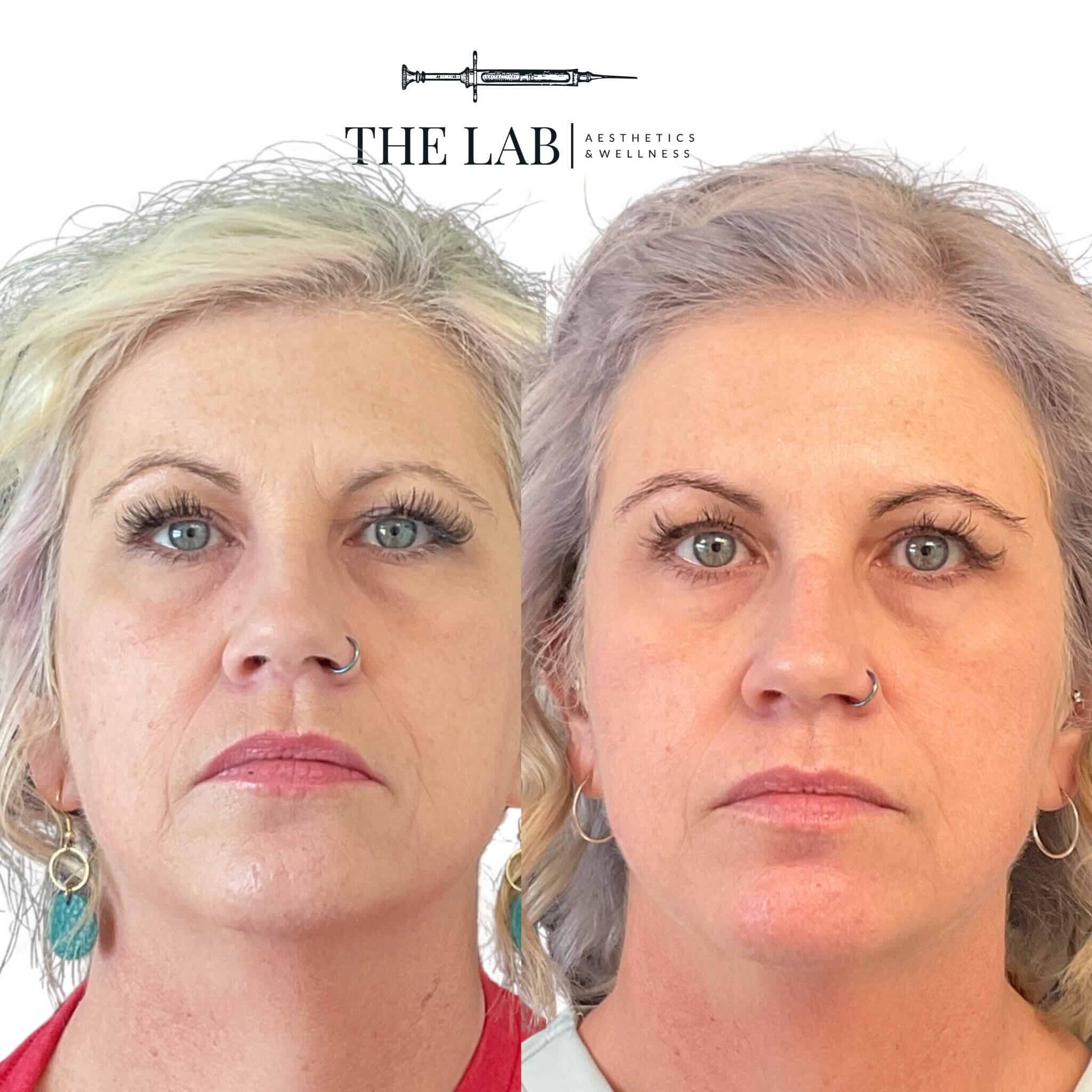 Full Face Botox Results at The LAB Aesthetics and Wellness