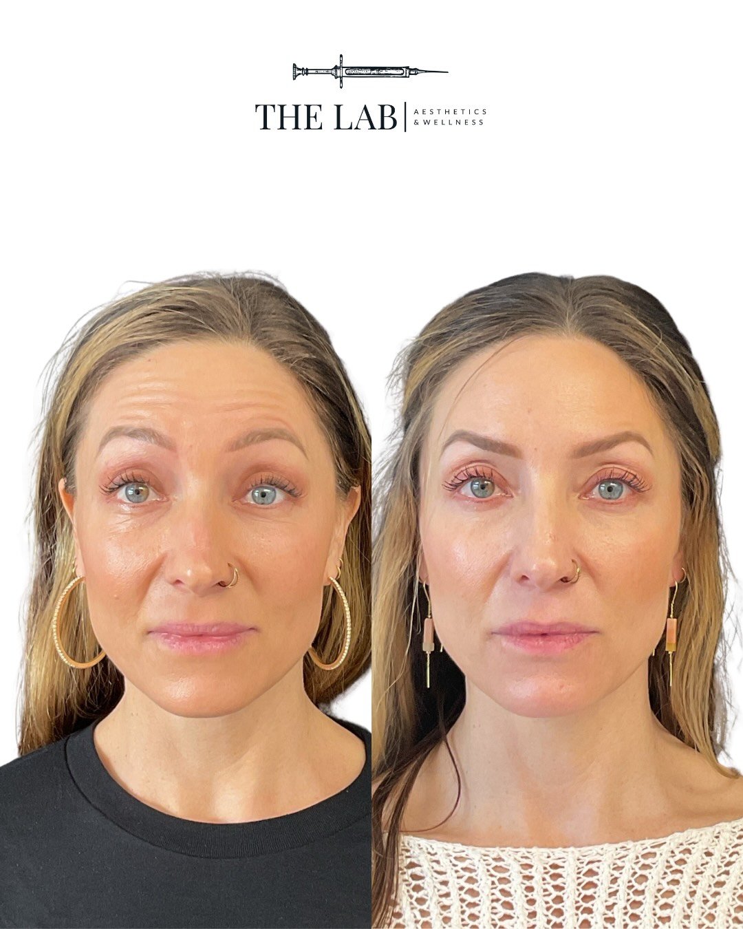 Botox Results at The LAB Aesthetics and Wellness