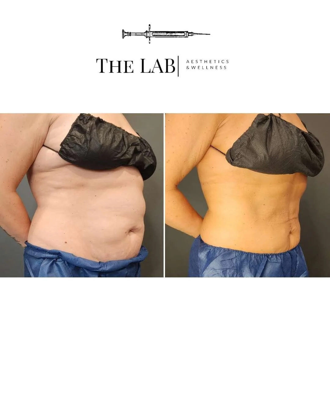 Before and after of coolsculpting