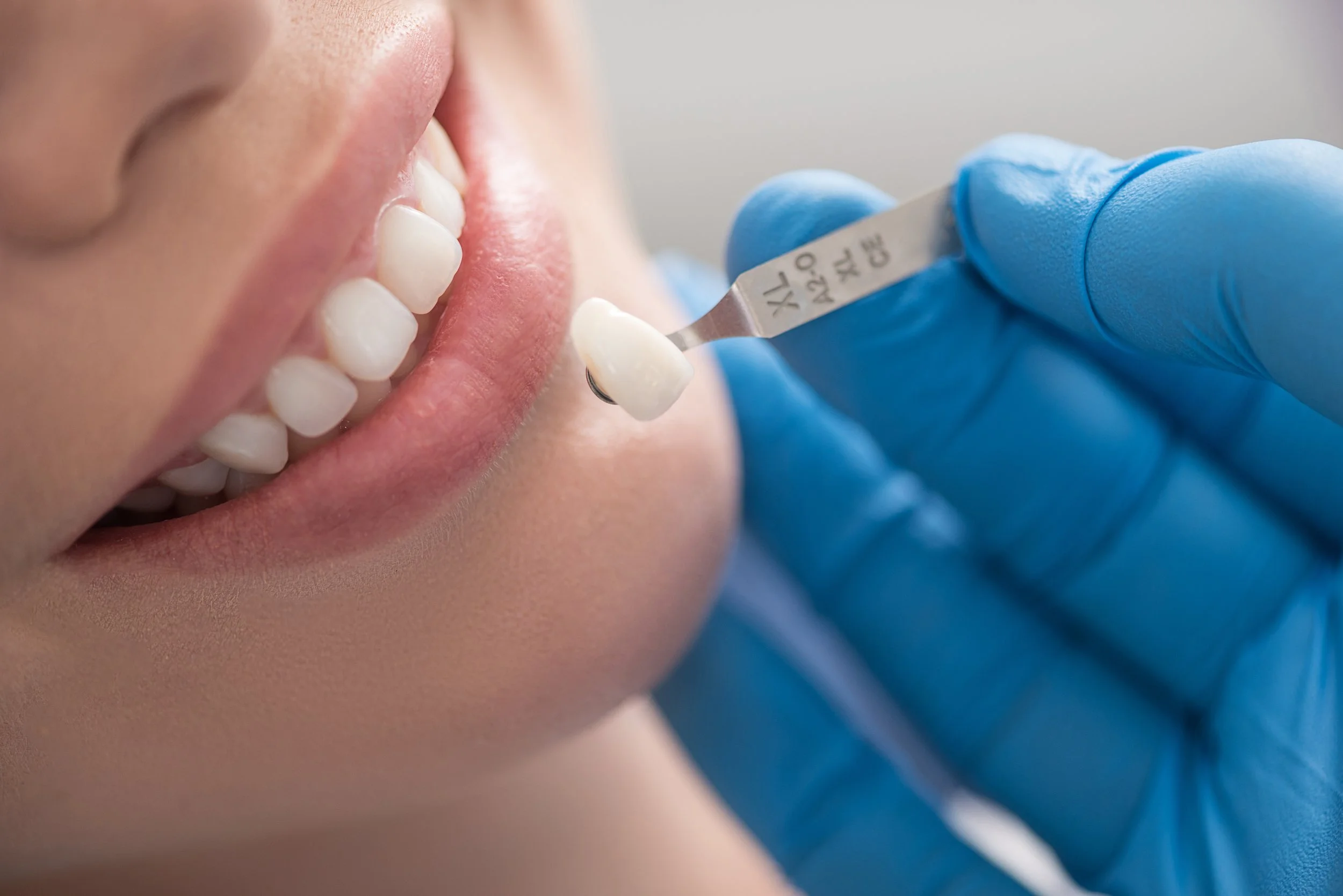 Dental Crowns & Bridges