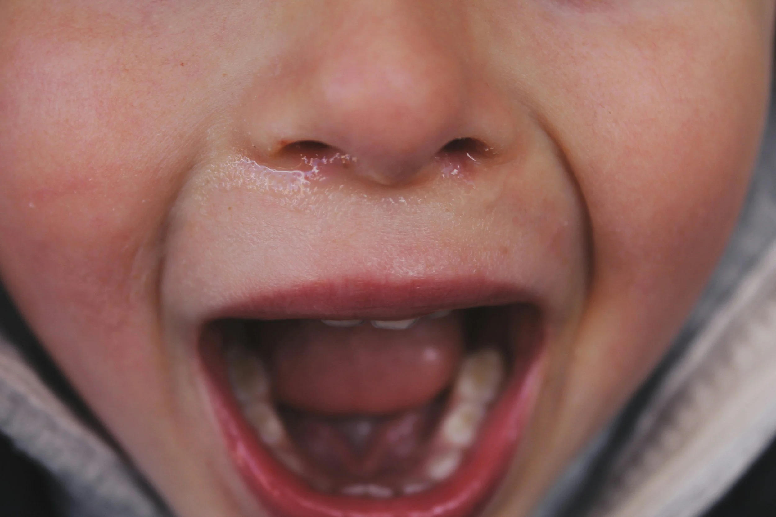 Case Study: Tongue Laceration