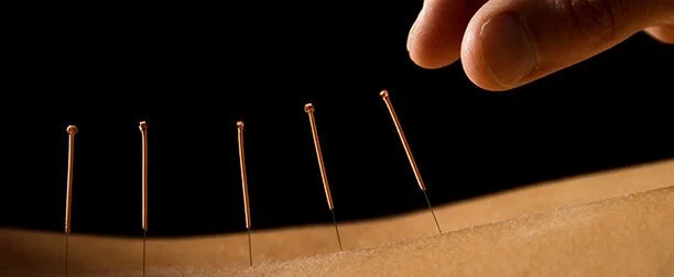 Acupuncture needles inserted into skin with a hand nearby on a dark background.