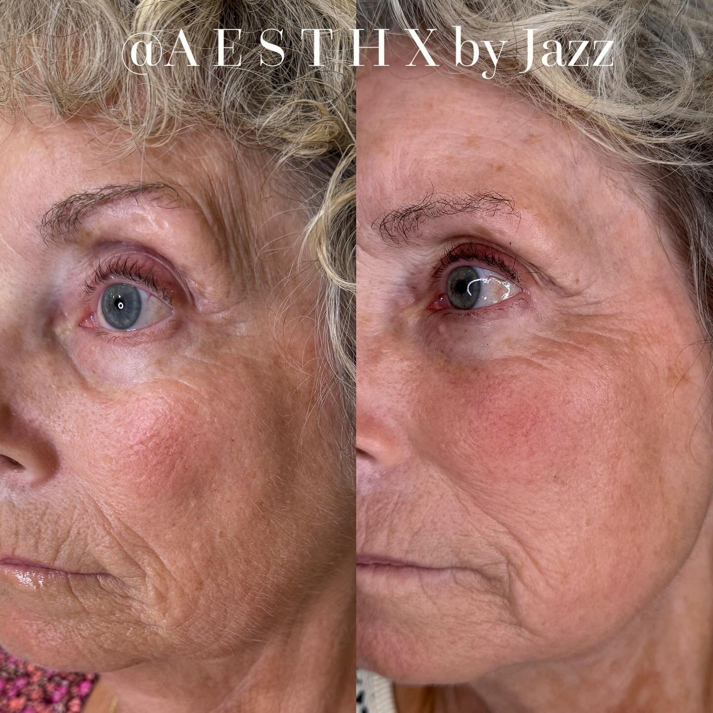 Treatment: Reverse! 

skin tightening helps improve the skin&rsquo;s elasticity and appearance, offering clients a way to rejuvenate their look without major surgery.

#aesthx