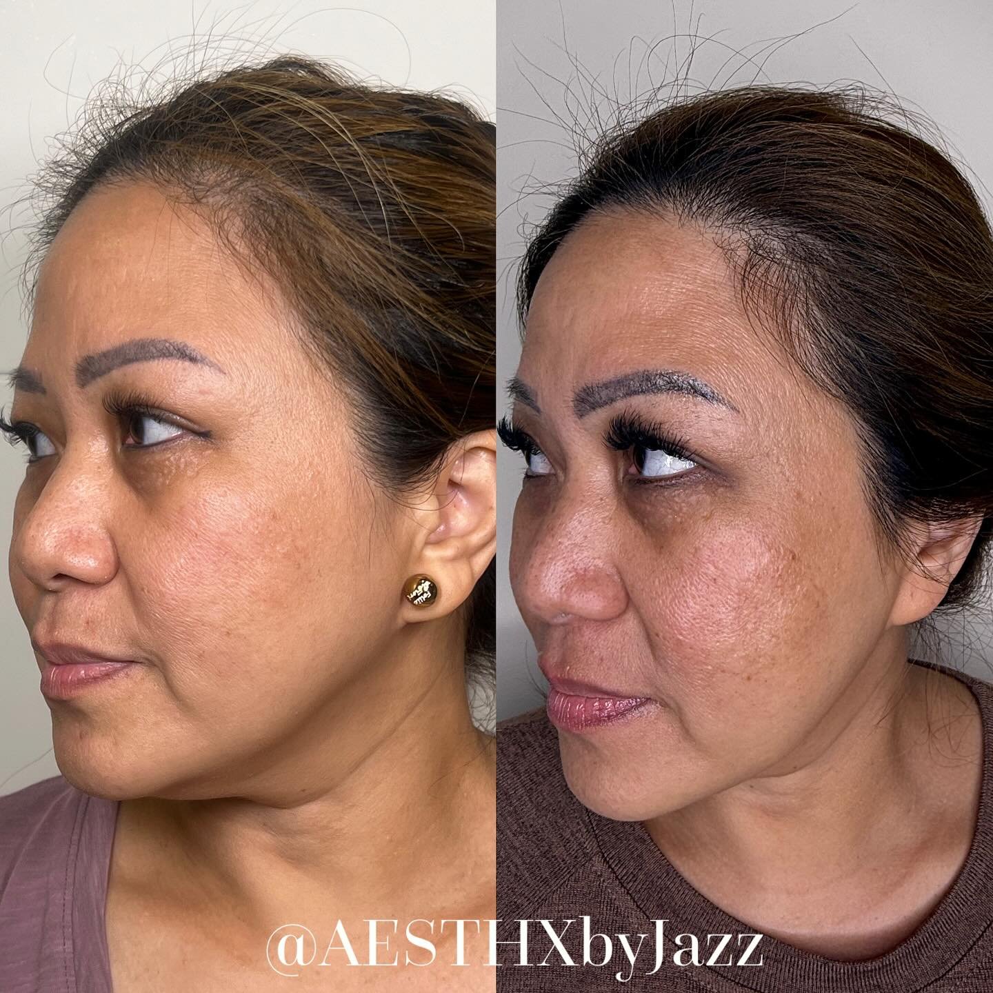 Achieve firmer, tighter skin for a youthful, radiant glow!

No down time and safe for all color skin tones 🫶🏼🫶🏽🫶🏾🫶🏿 

#firmertighterskin #skinrejuvenation #aesthx