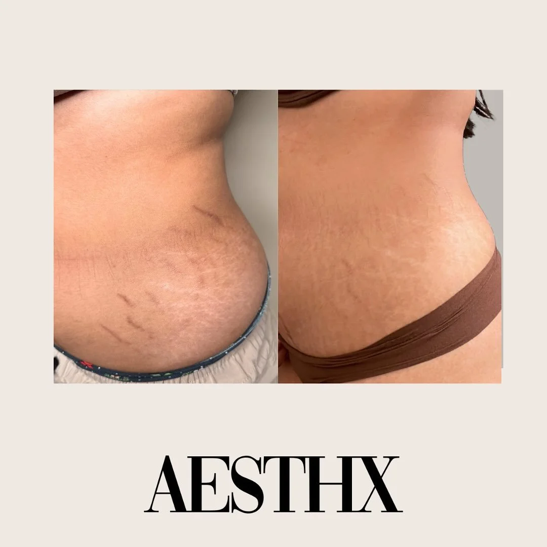🚫 No more hiding. No more filters.
Our laser makes stretch marks fade like they were never there.
Your skin, but better.🤍

📍98-1005 Moanalua Rd AESTHX
Monday-Saturday 10am-7pm
🔗Link in bio

#aesthx #stretchmarks #lasertreatments #areolase #neolas