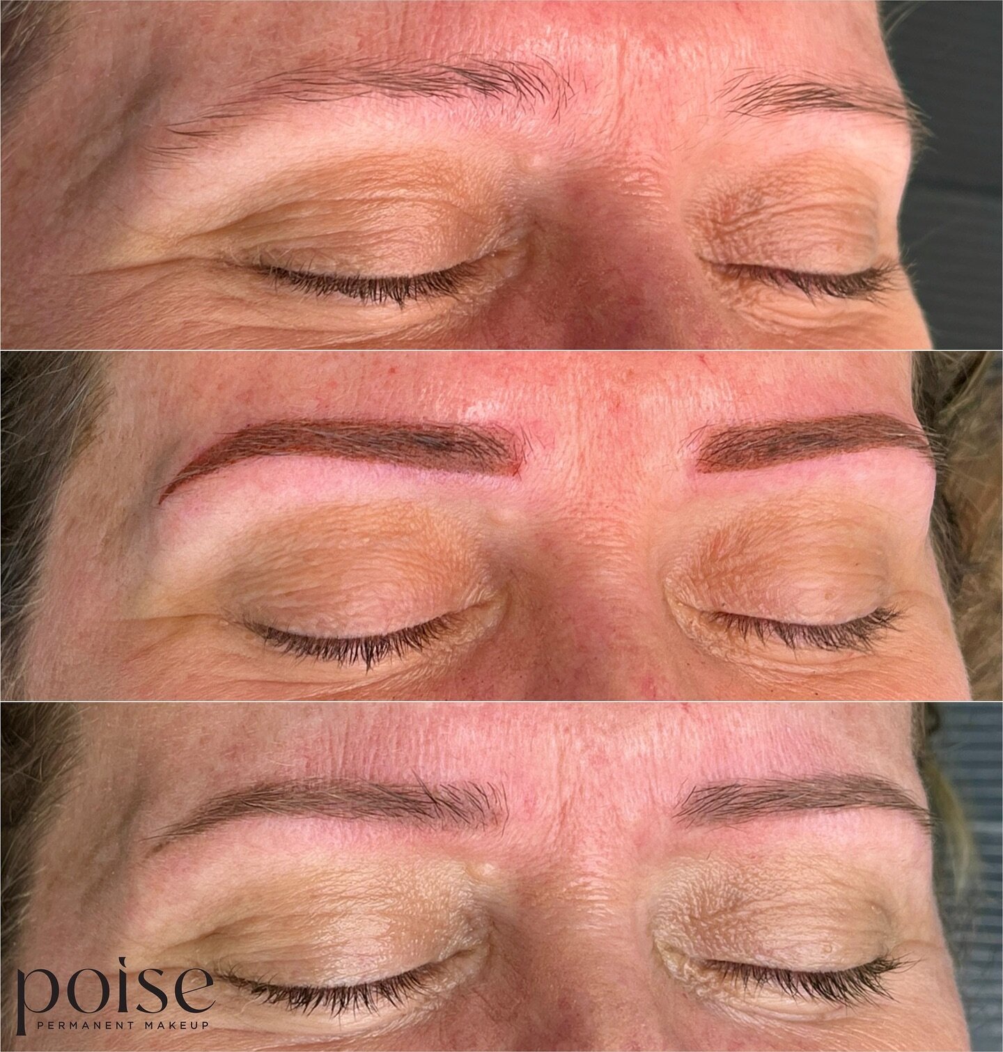 Your eyebrows but better ❤️

This lady drew on a very natural eyebrow pencil daily so I wanted to keep the finish of the tattoo in line with that. 

1. Natural before
2. Straight after - you can see a lot of warmth from the pigment and also trauma to