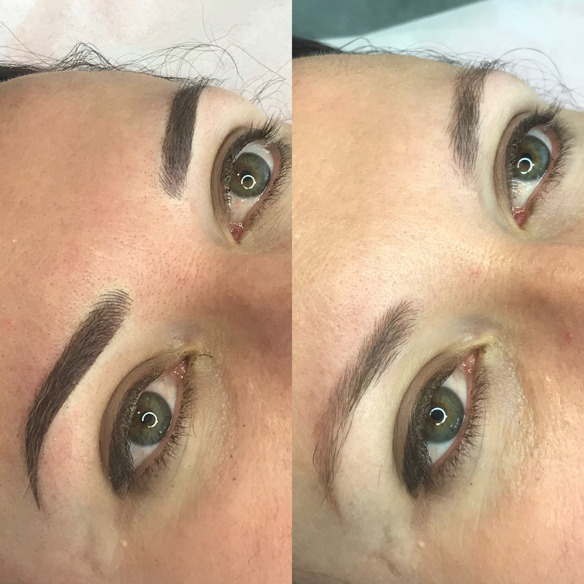 Combo brows correction procedure.JPG