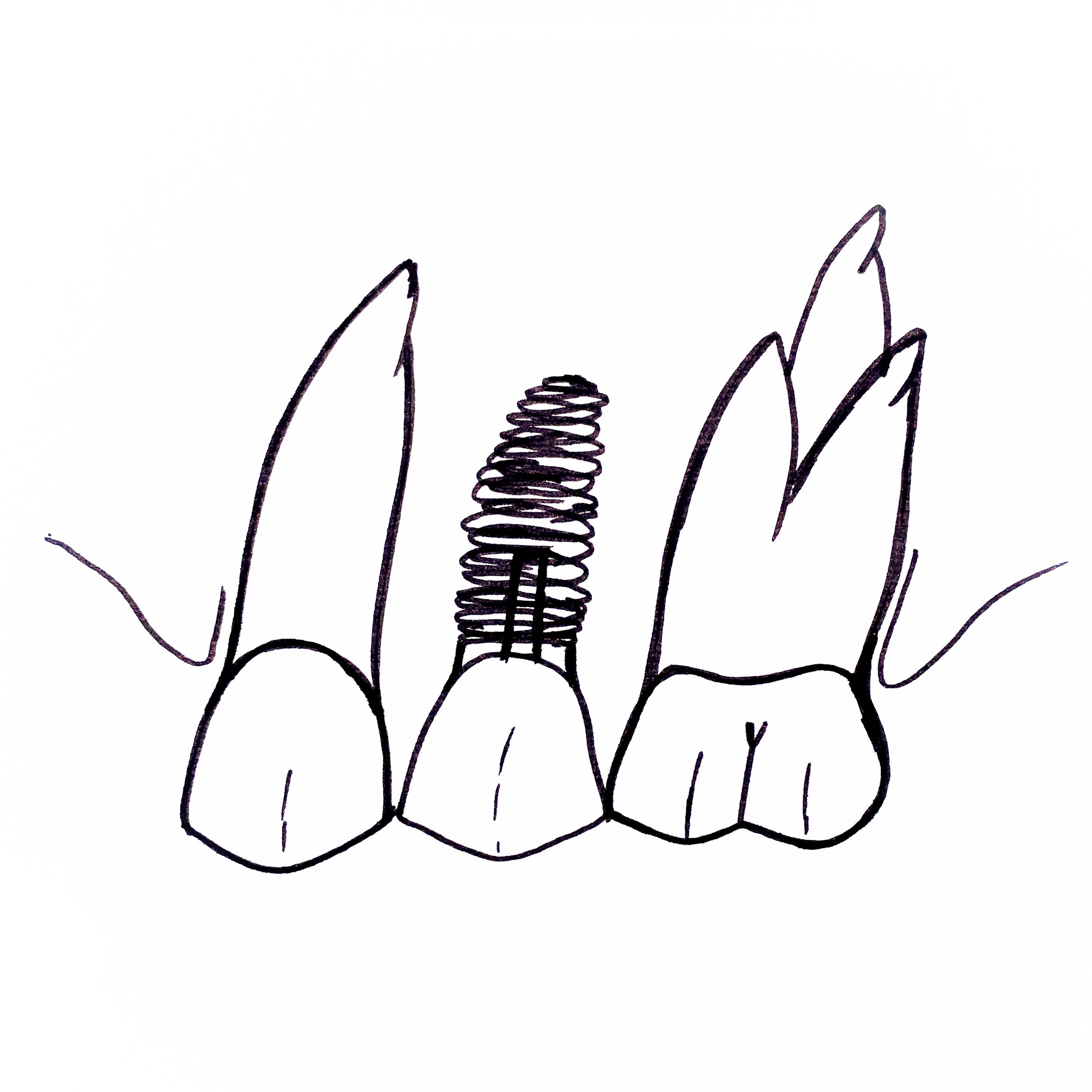 Zahnarzt Linz_Implantat.jpg