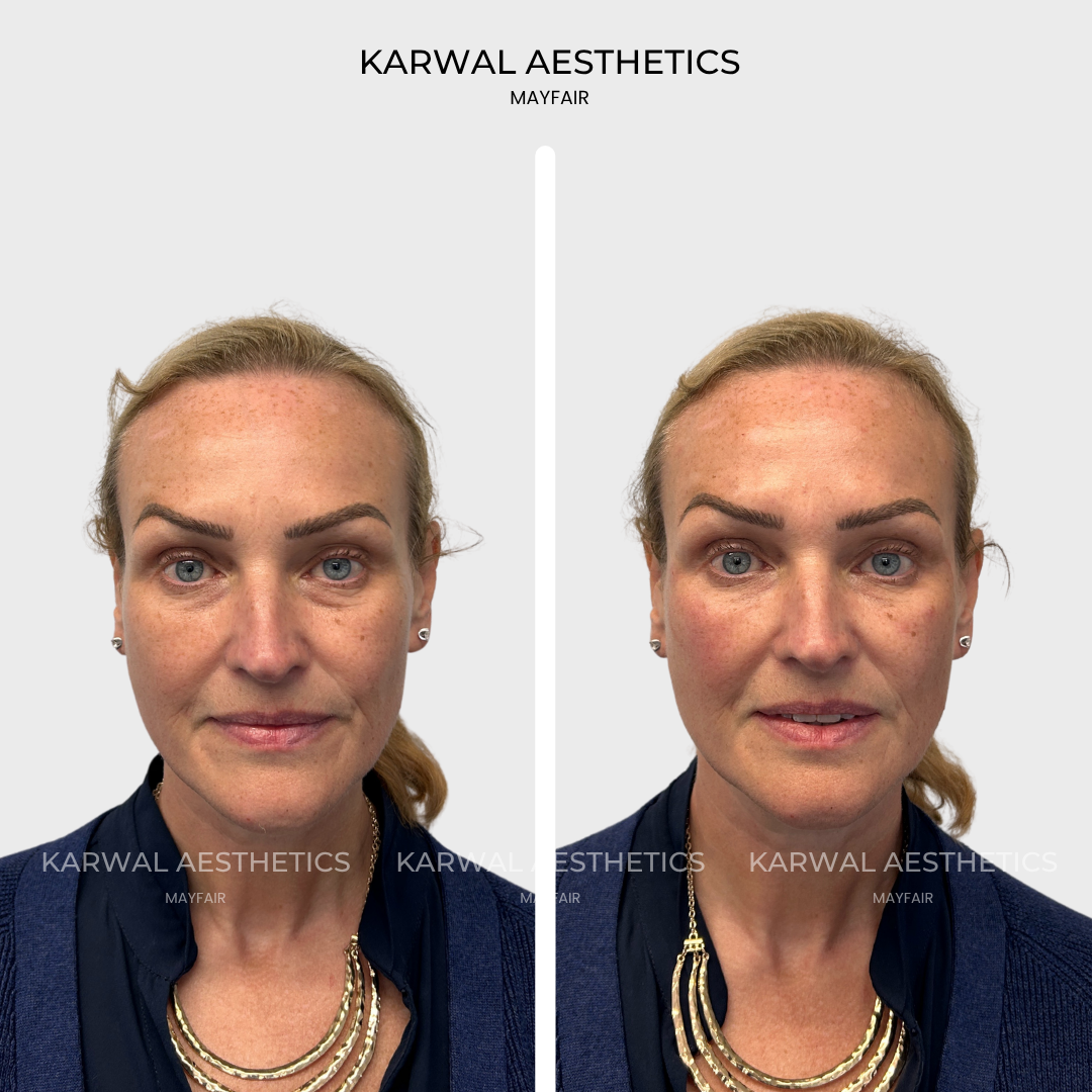 Under eye, tear trough filler result. London.
