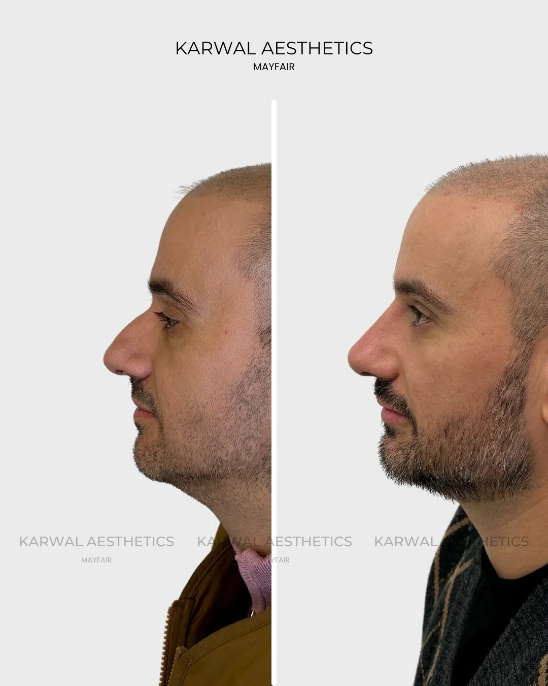Non Surgical Rhinoplasty Result Karwal Aesthetics