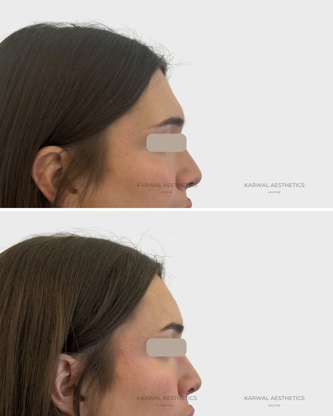 Forehead filler result - Karwal Aesthetics London