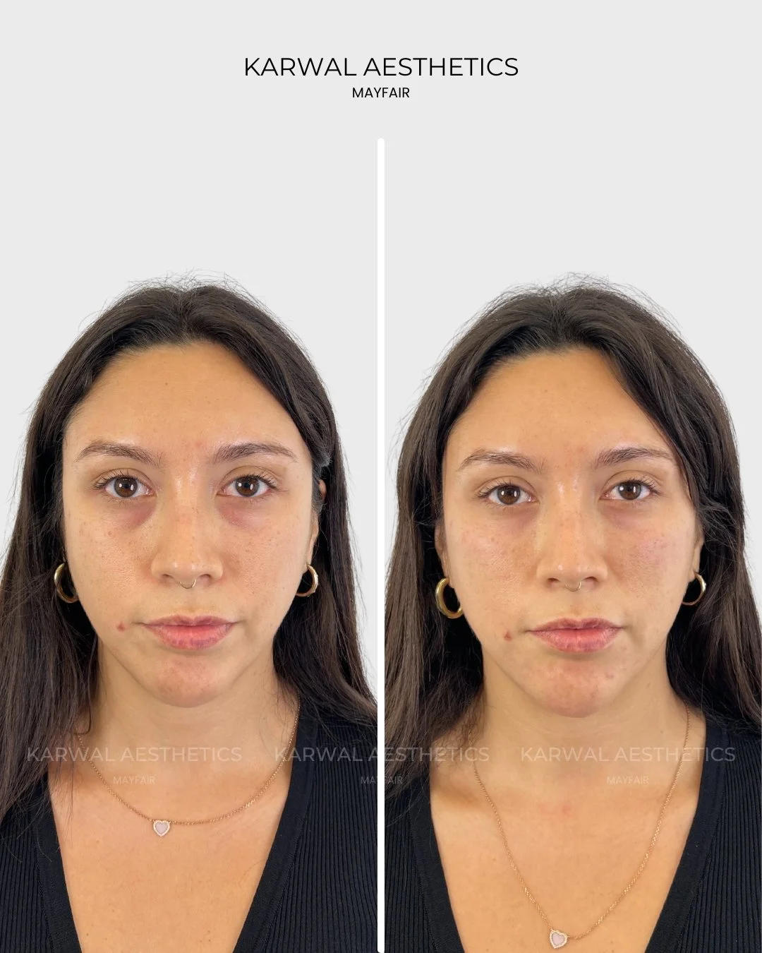 Tear Trough Filler Before and After | Karwal Aesthetics London