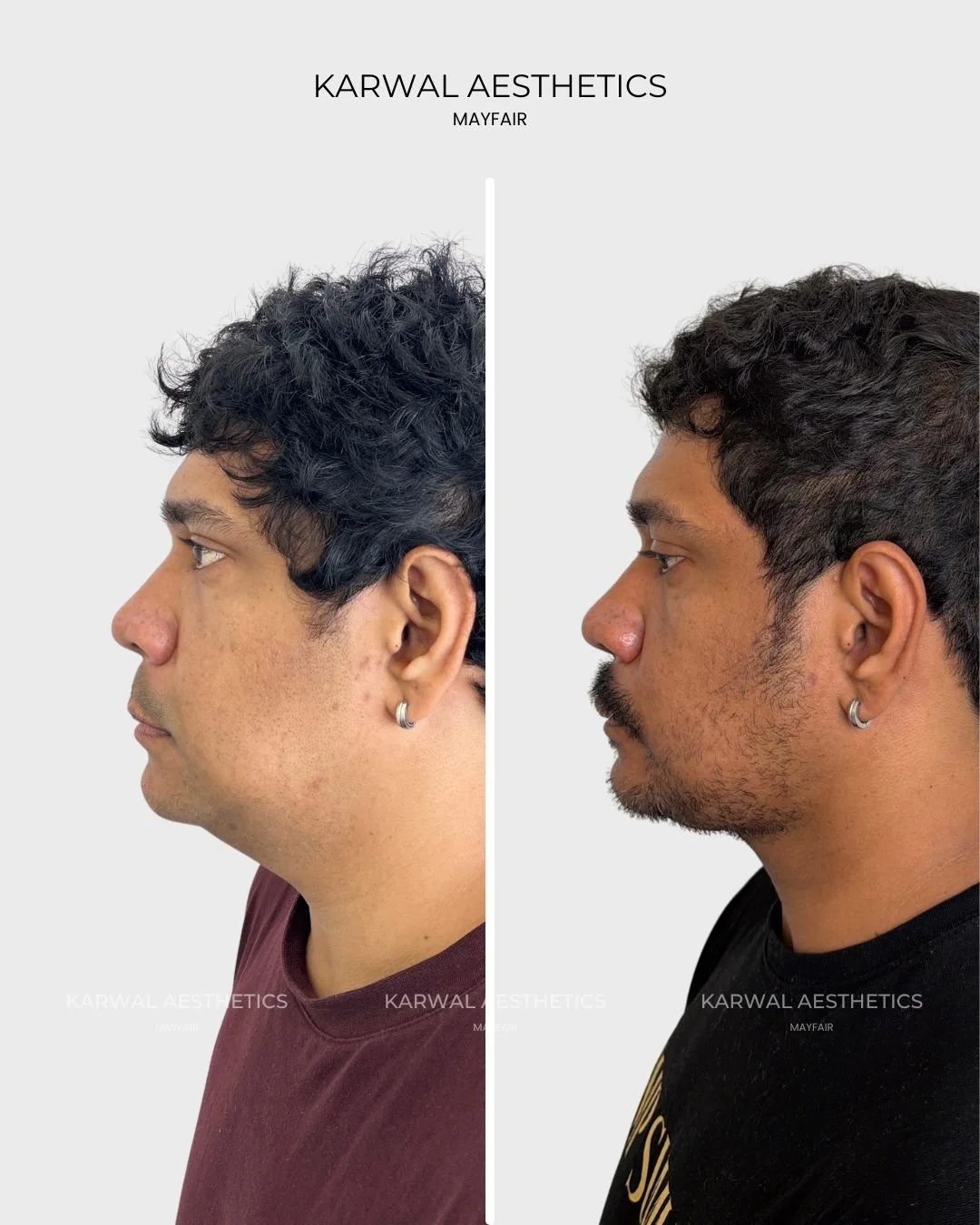 Endolift result by Dr Karwal London