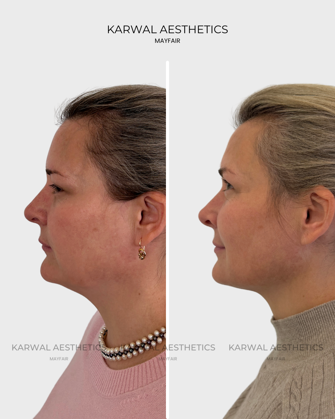 Endolift result at Karwal Aesthetics London