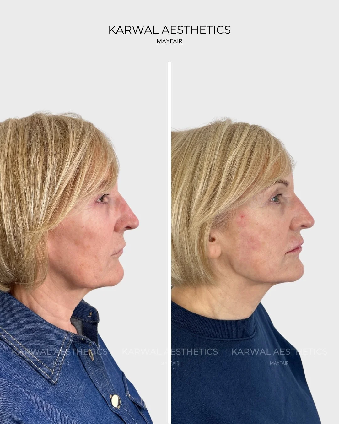 Endolift before and after - Karwal Aesthetics London