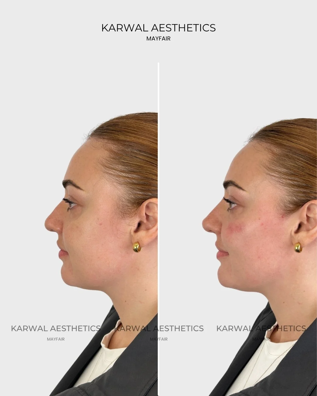 Non Surgical Rhinoplasty Result Karwal Aesthetics