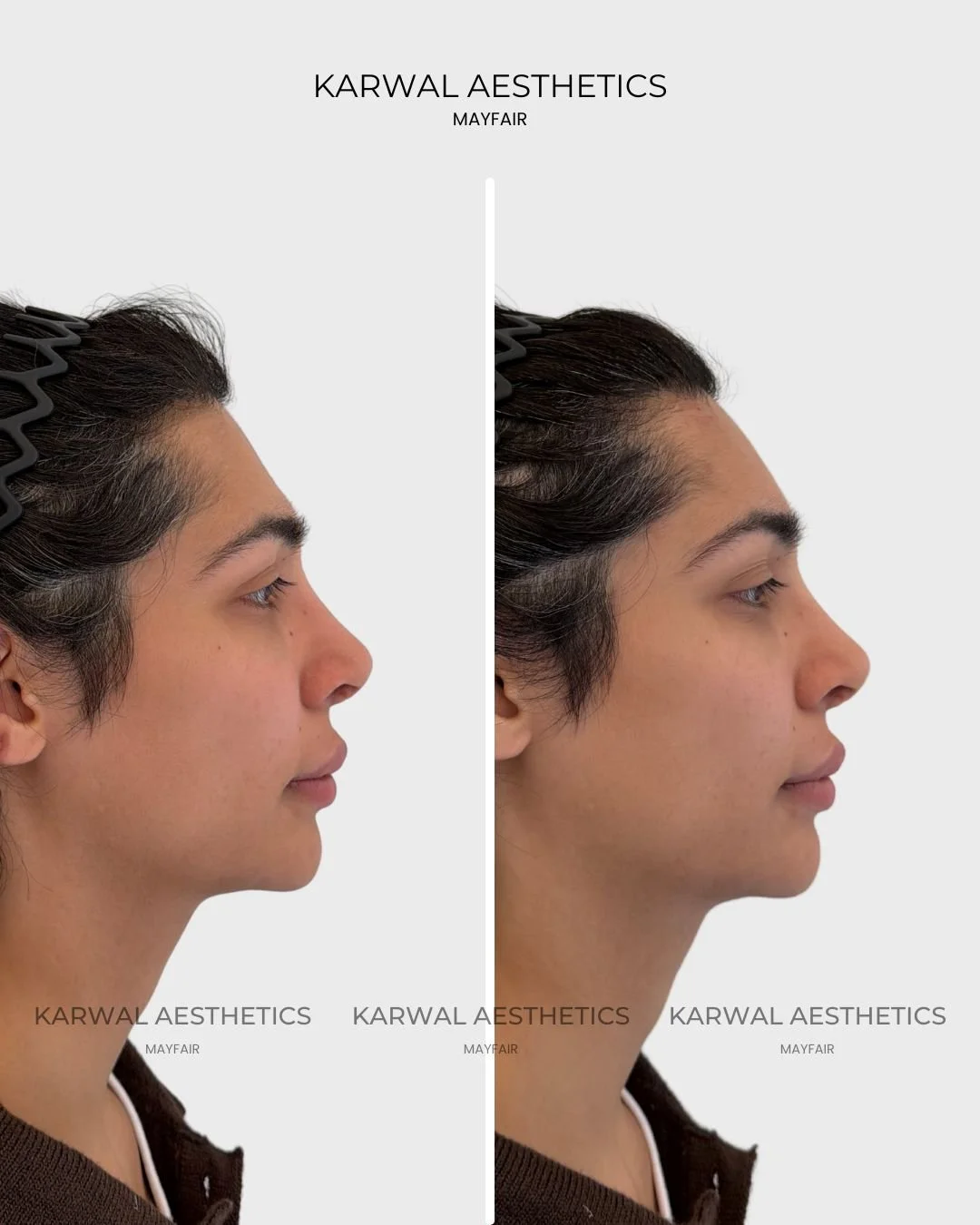 Forehead Filler Result - Karwal Aesthetics London