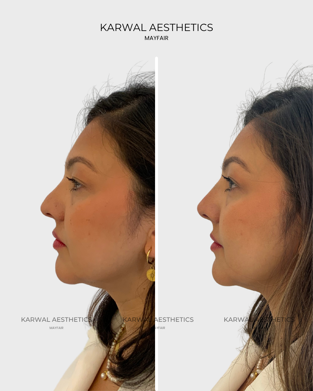 Non surgical rhinoplasty Karwal Aesthetics result London