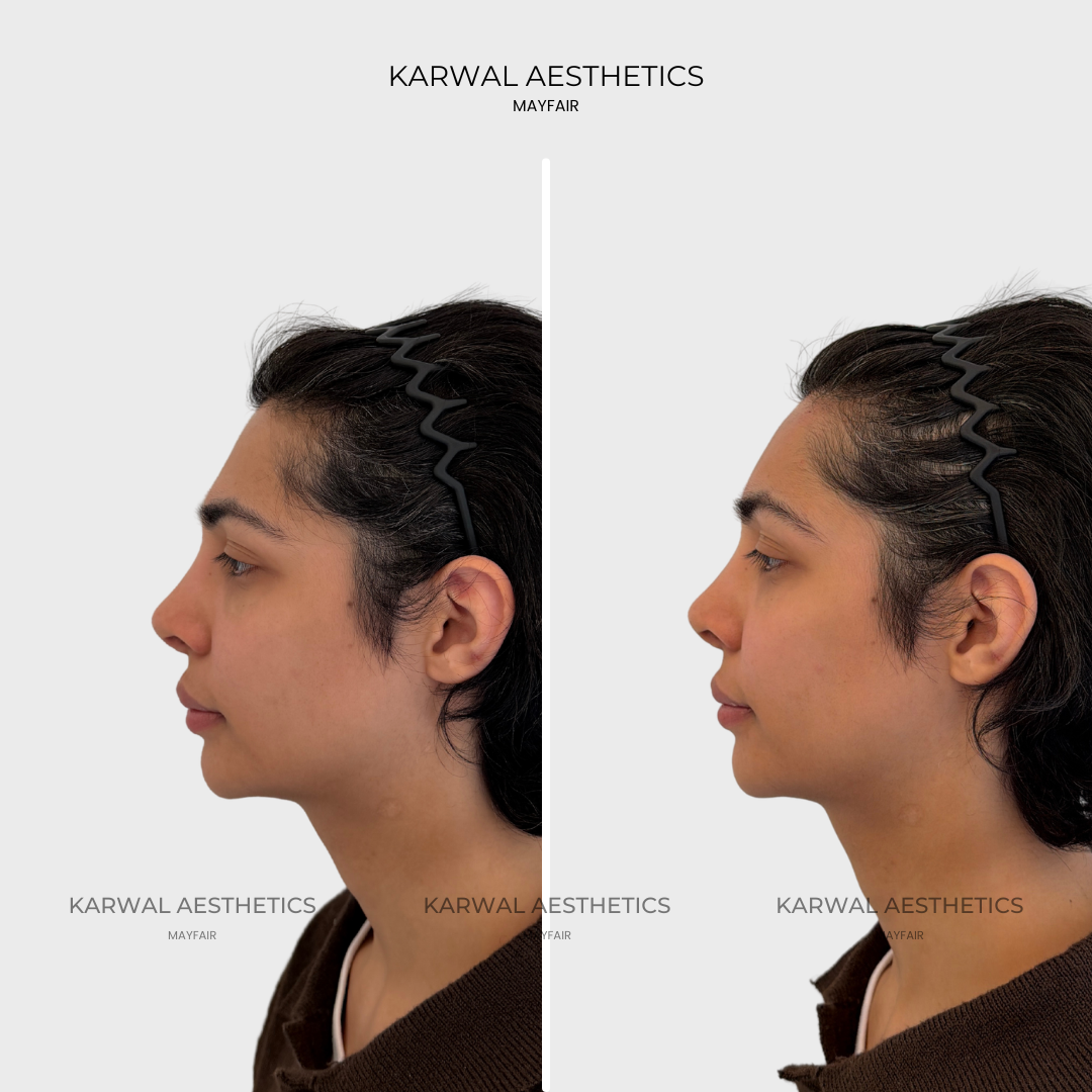 Flat or Concave Forehead? Why Shape Matters More Than Lines