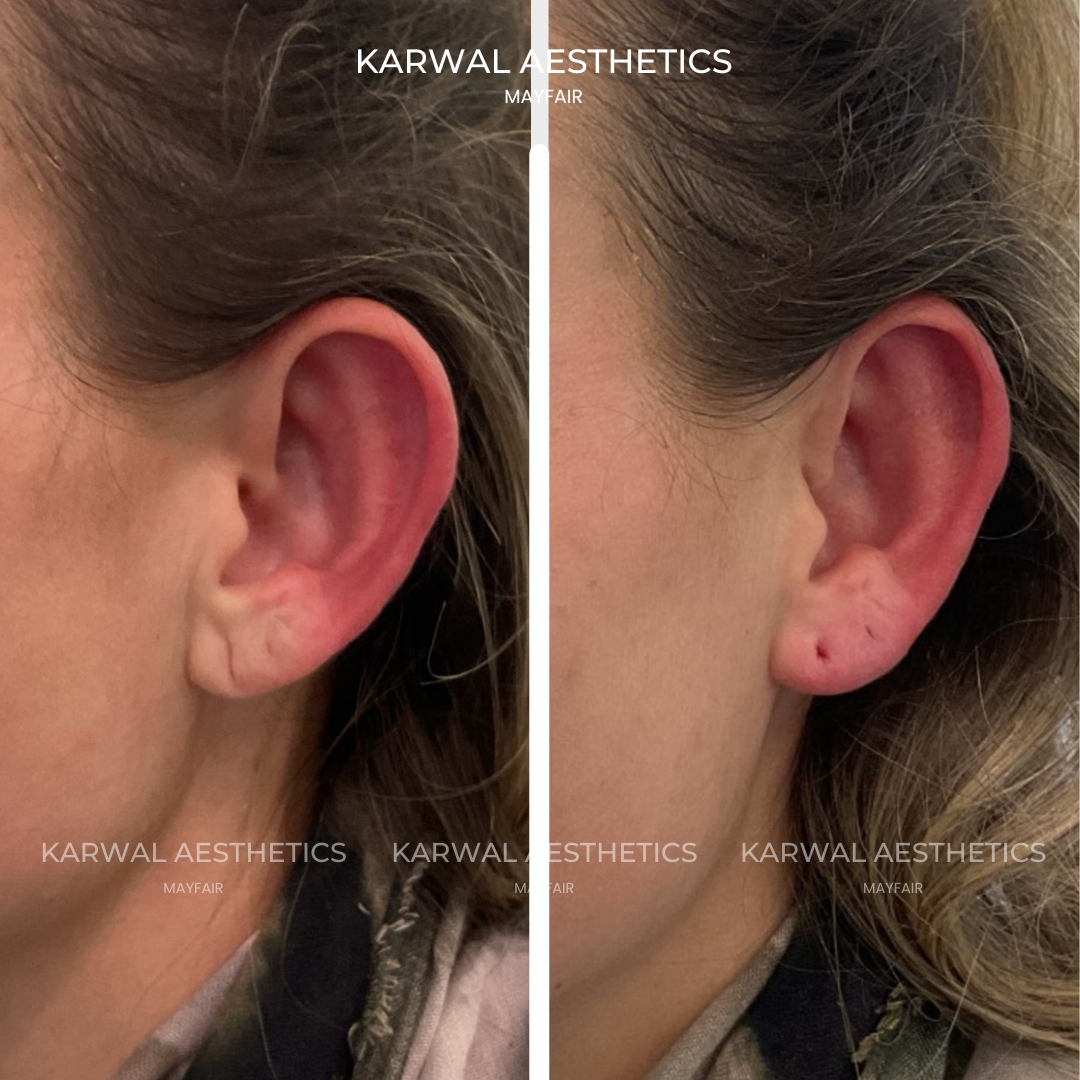 Restore Your Ear Lobes