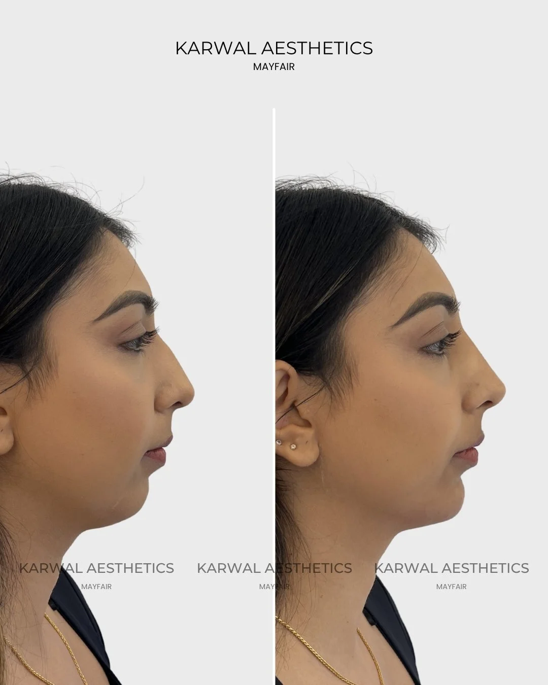 Non Surgical Rhinoplasty Result Karwal Aesthetics