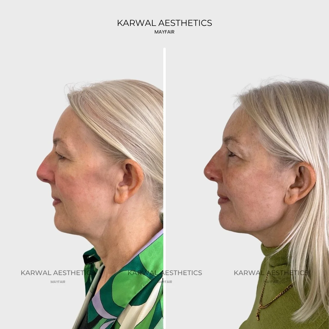 Endolift result Karwal Aesthetics London
