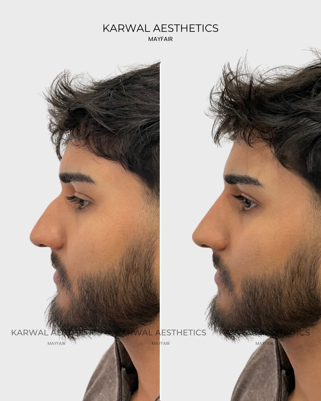 Non Surgical Rhinoplasty Result Karwal Aesthetics