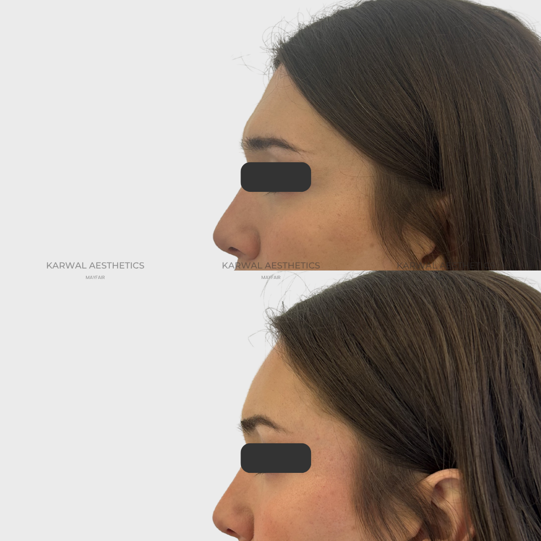 Before and after forehead filler at Karwal Aesthetics London showing a straighter nose profile after dermal filler.