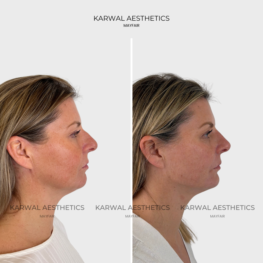 Endolift before and after result at Karwal Aesthetics, London.