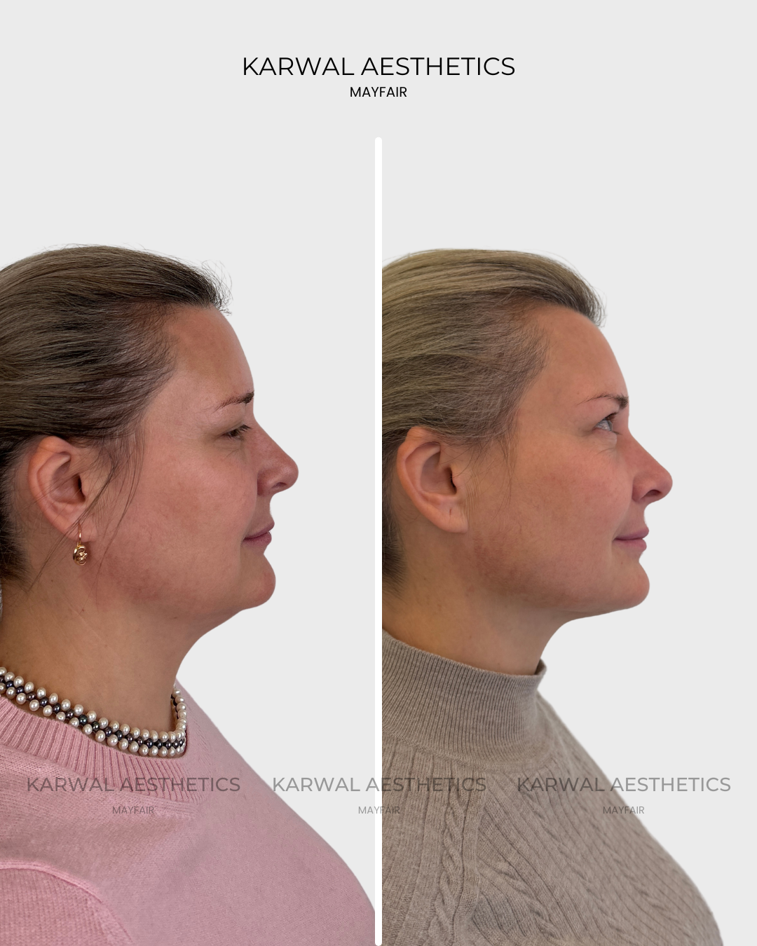 Endolift result by Dr Karwal London