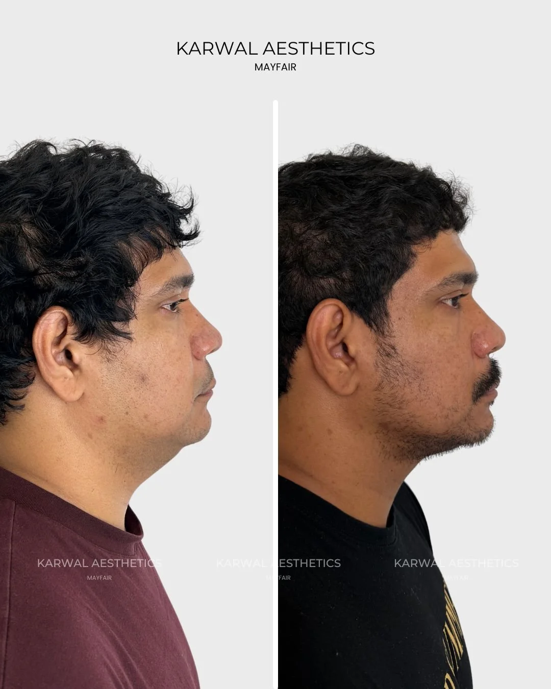 Endolift result by Dr Karwal London