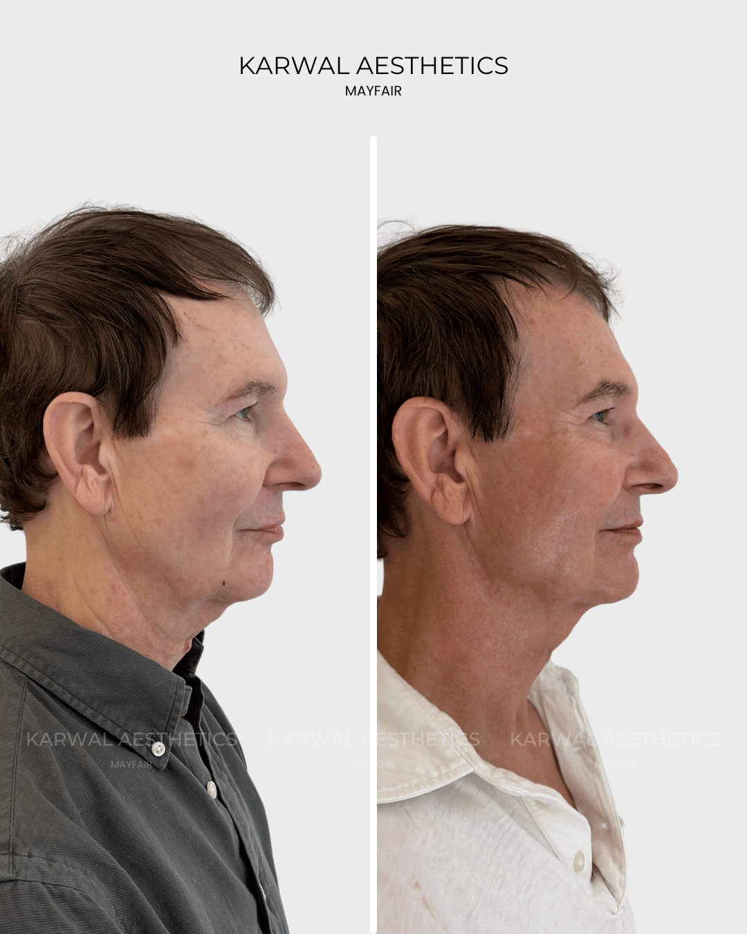Endolift lower face, under chin and neck before and after, Karwal Aesthetics London