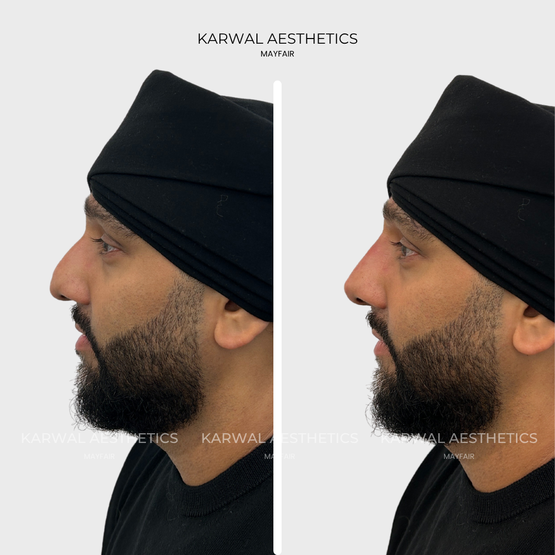 Non surgical rhinoplasty, nose filler result, London.