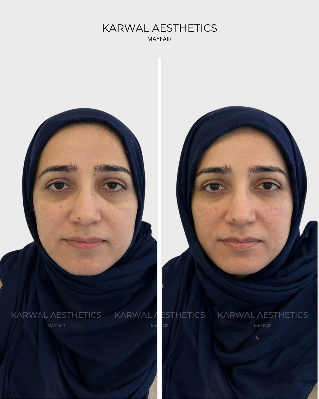 Tear Trough Filler Before and After | Karwal Aesthetics London
