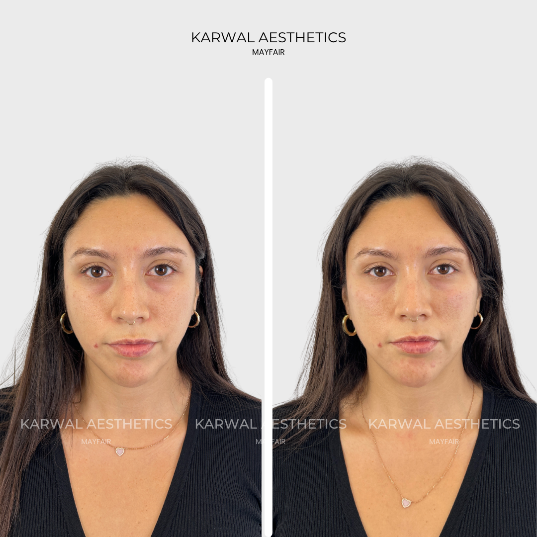 Under eye filler, London.