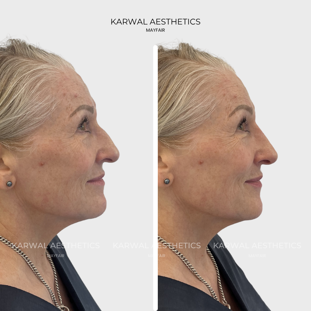 Non surgical rhinoplasty, nose filler result, London.