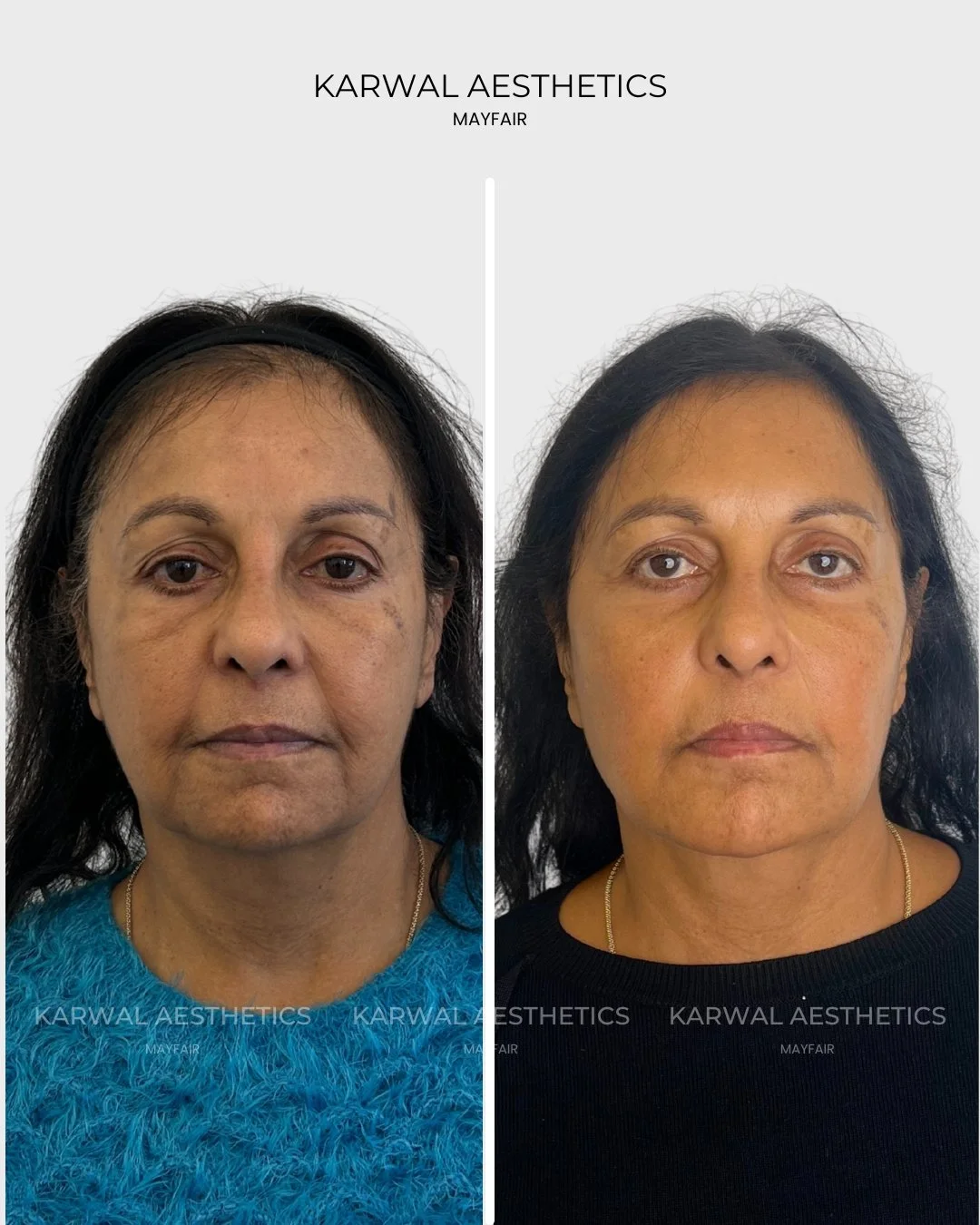 Endolift before and after - Karwal Aesthetics London