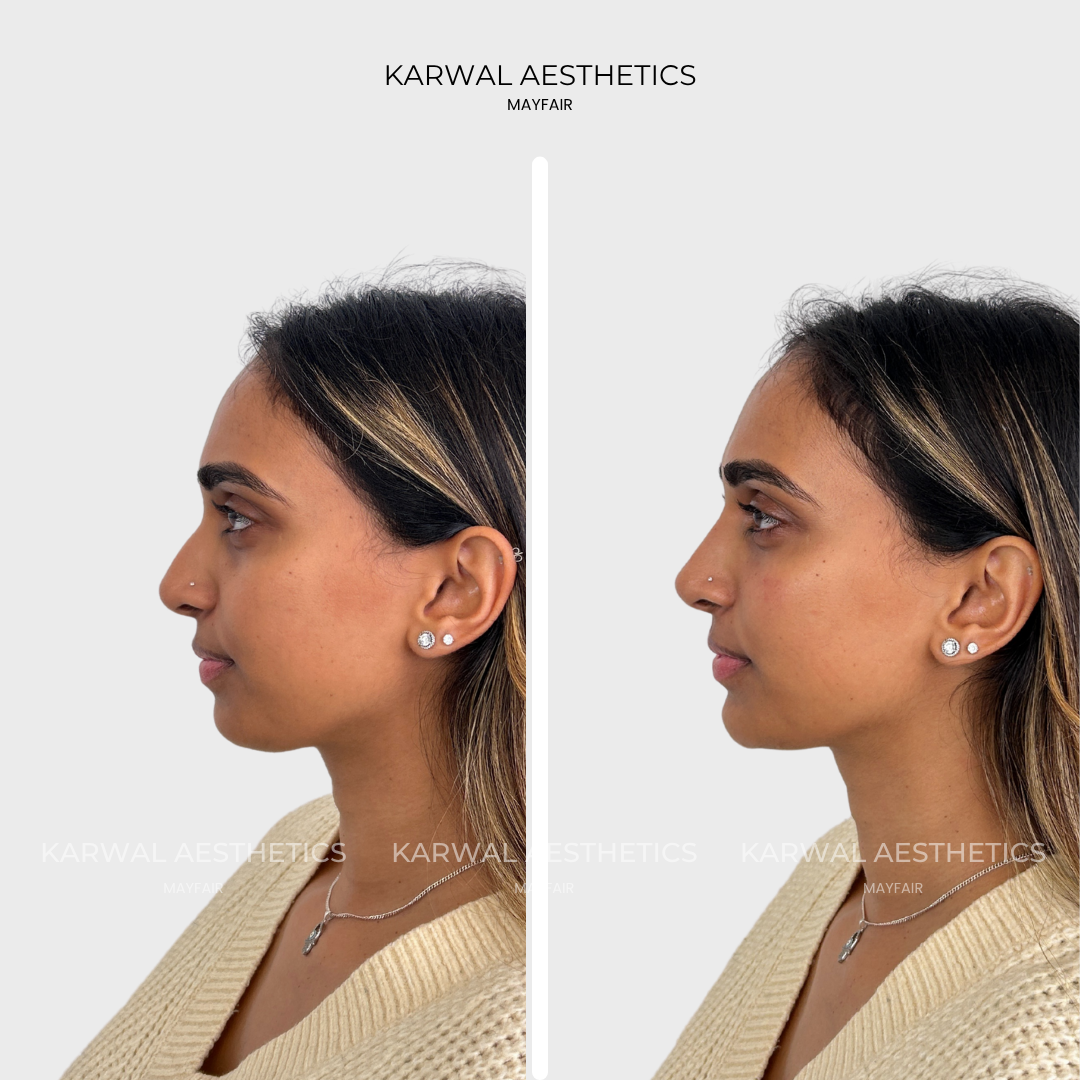 Profile balancing result, non surgical rhinoplasty and chin filler, London.