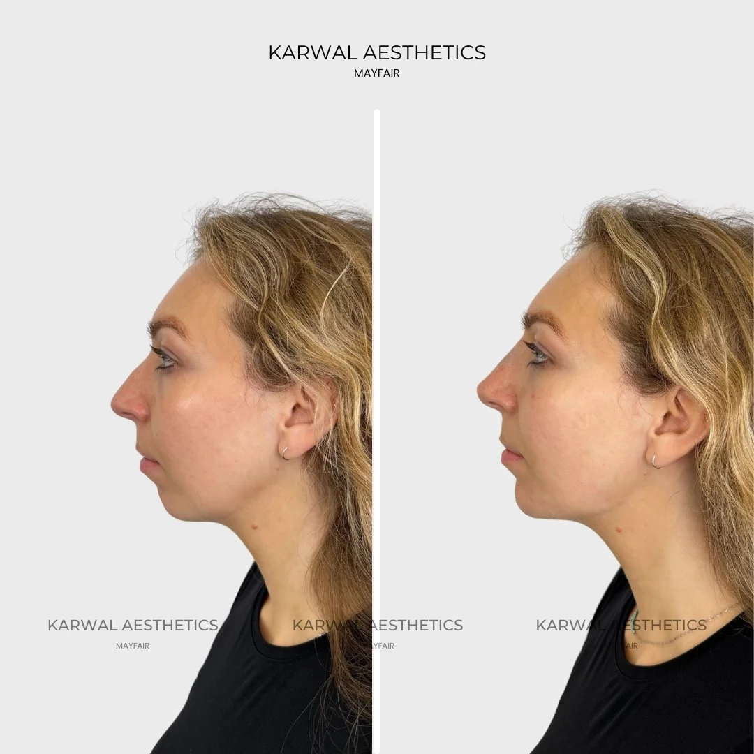 chin filler