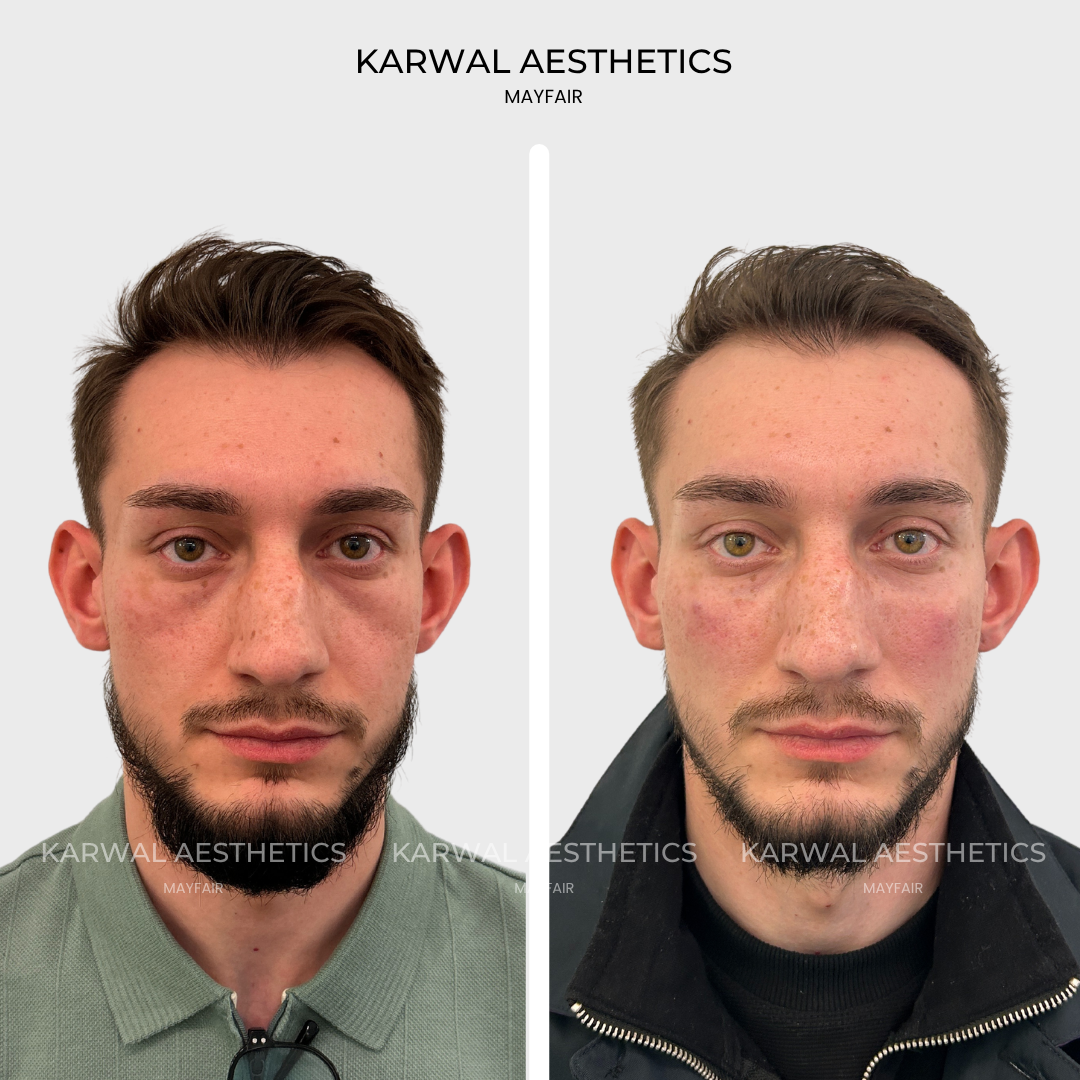 Tear trough filler and anterior cheek filler result, London.