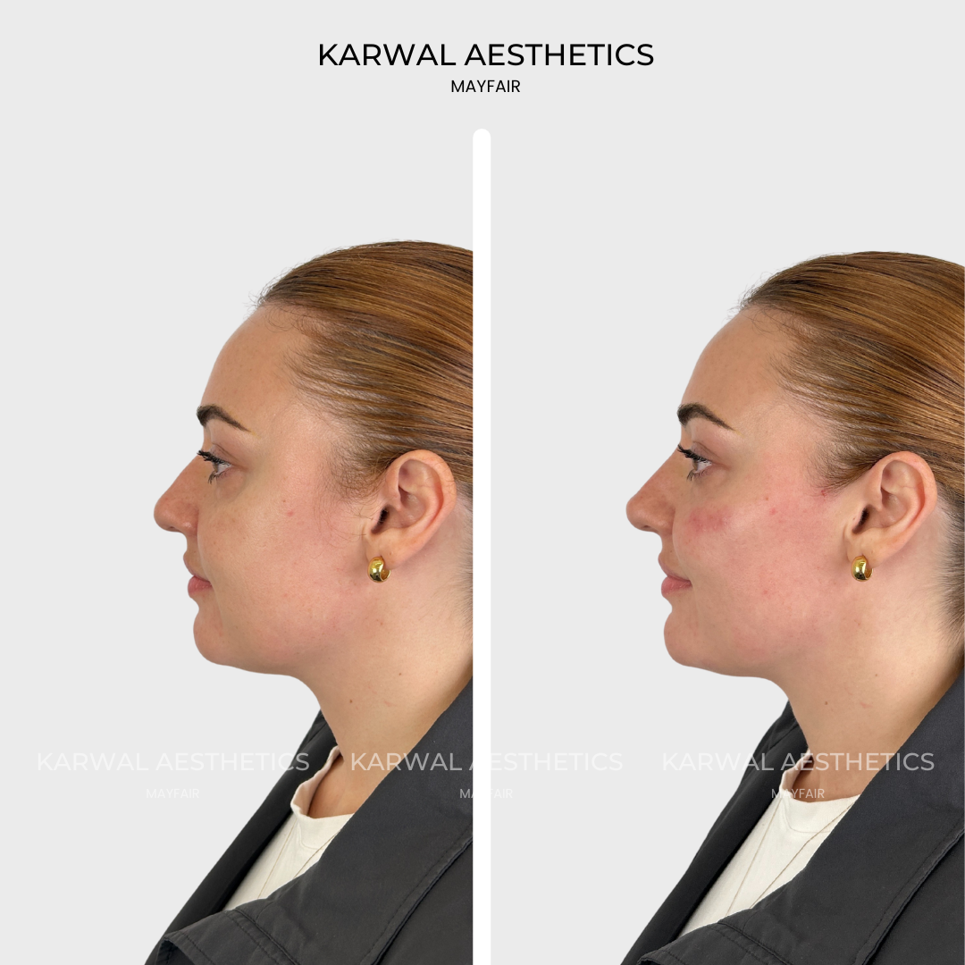 non surgical r.png