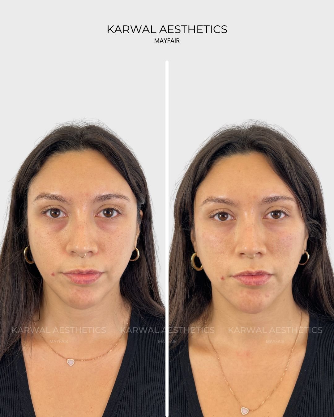 Tear Trough Filler Before and After London