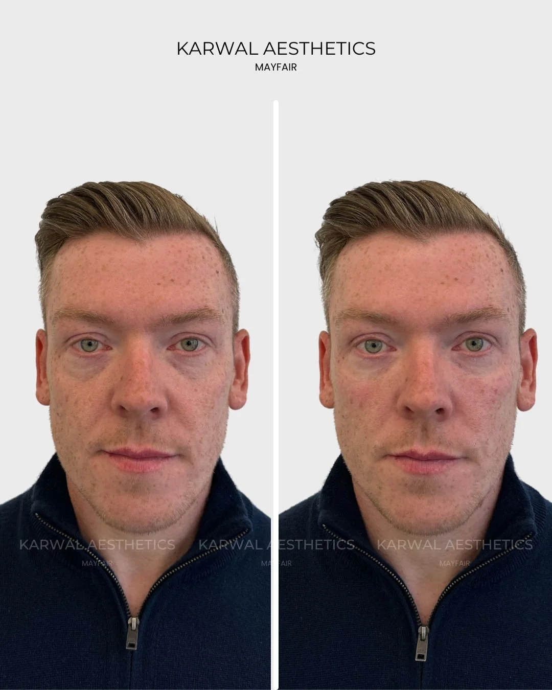 Tear trough filler before and after result, Karwal Aesthetics, London.